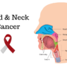 Head and Neck Cancer