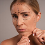 Dermal filler for acne scars