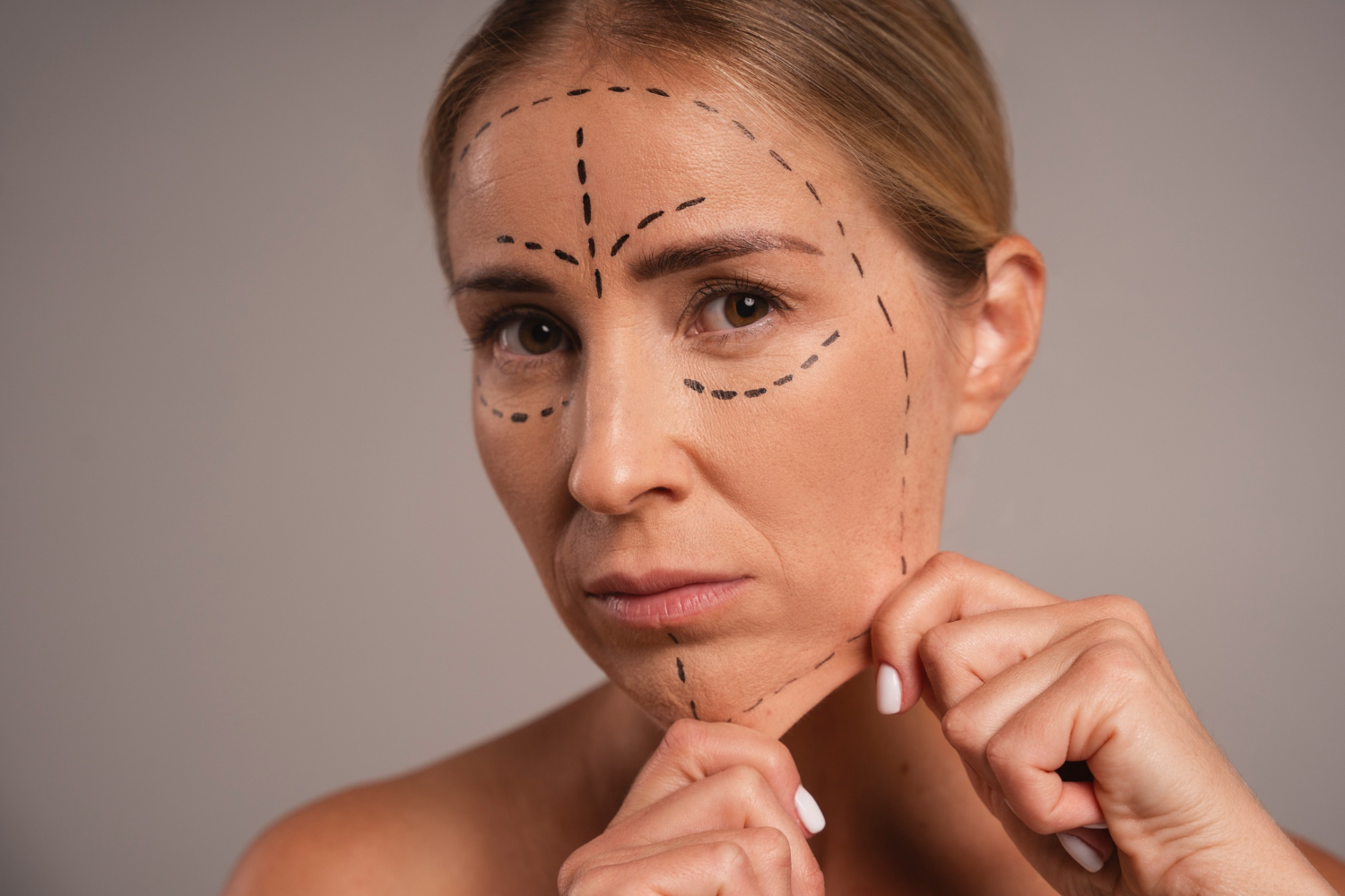 Dermal filler for acne scars
