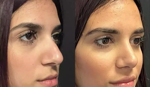 Trends and Considerations for Male Rhinoplasty in Dubai