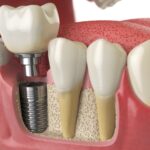Clinicas dentales en hospitalet de llobregat