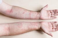 How Skin Diseases Treatment Combats Bacterial Issues
