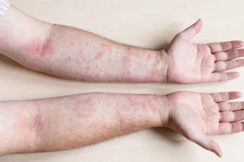 How Skin Diseases Treatment Combats Bacterial Issues