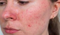 Is Rosacea Treatment Suitable for Men and Women?