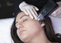 Is Morpheus 8 Treatment Better Than Microneedling?