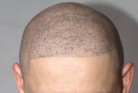 Is Scalp Micropigmentation Safe for All Types